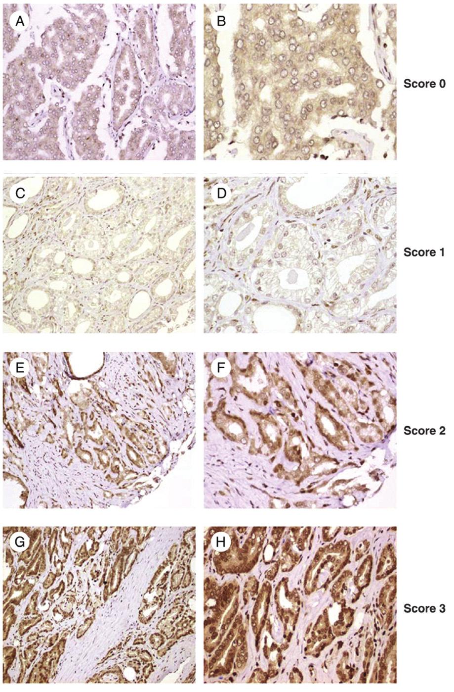 2674 CHEN et al: NOB1 IN PROSTATE CANCER Figure 3. Immunohistochemical detection of NOB1 in PCa.