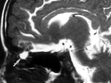 Vertigo, tinnitus, paresthesia Complex partial seizures Circling epilepsy Paroxysmal walking in small