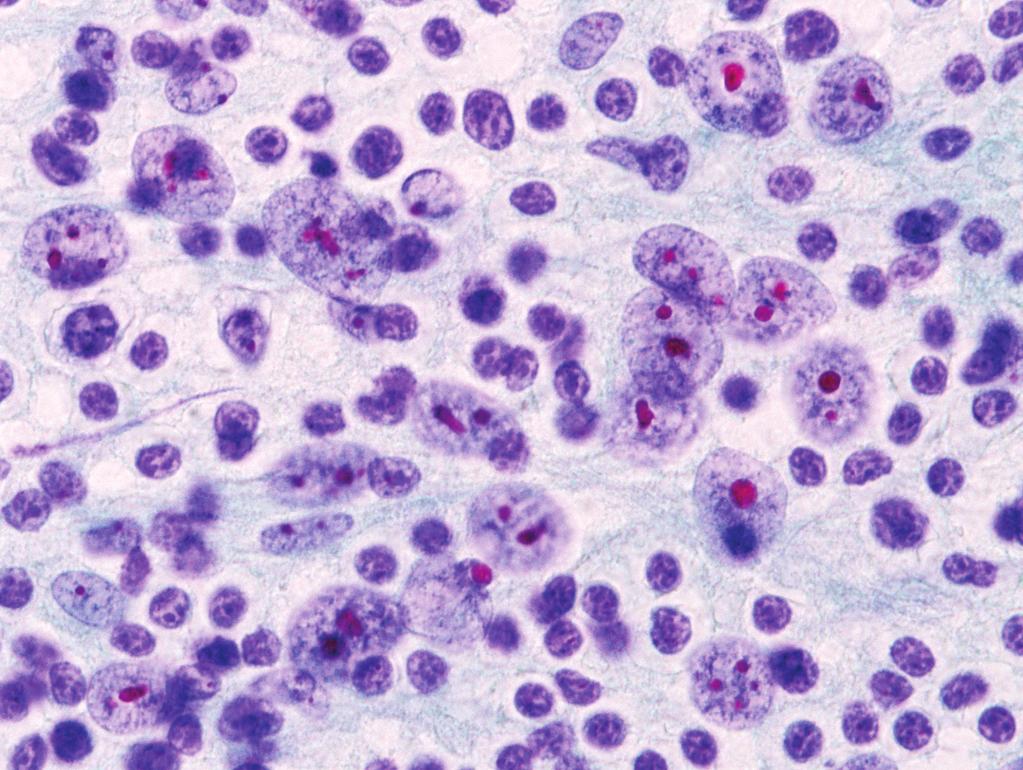 591 Cytology of Follicular Dendritic Cell Sarcoma C D Fig. 2.