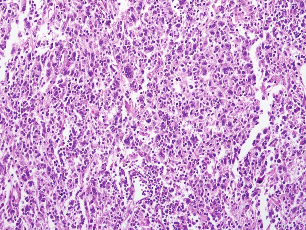 Histologic, electron microscopic, and immunohistochemical findings.