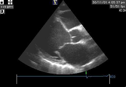 2D-Echo: dilated LV with EF=20-30%.