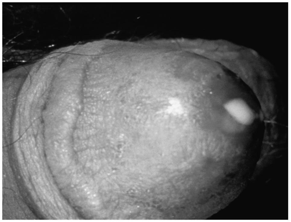 Figure 26.6 Pus-containing discharge from the urethra of a man with an acute case of gonorrhea.