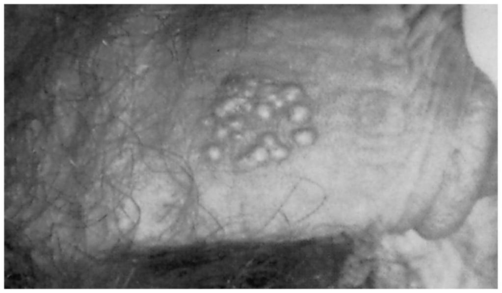 Figure 26.14 Vesicles of genital herpes on a penis.