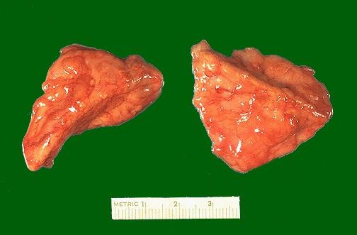 Adrenal Gland, gross specimen Here are normal adrenal glands.