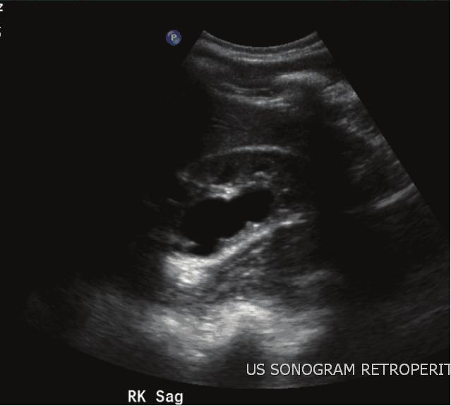 2 Case Reports in Urology Figure 1: Ultrasound of right kidney read as pelviectasis and possible renal cysts.