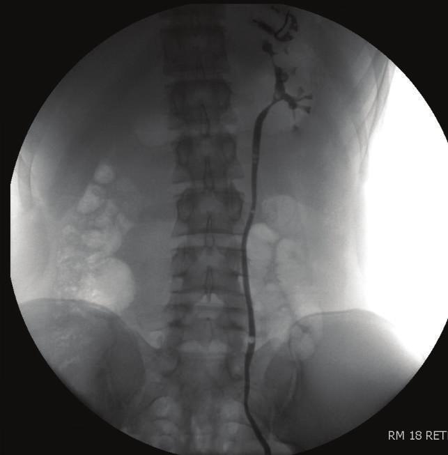 The differential diagnosis at this point included an obstructive process within a duplex system such as ureteropelvic junction obstruction or calyceal diverticulum, cystic kidney disease, malignancy,