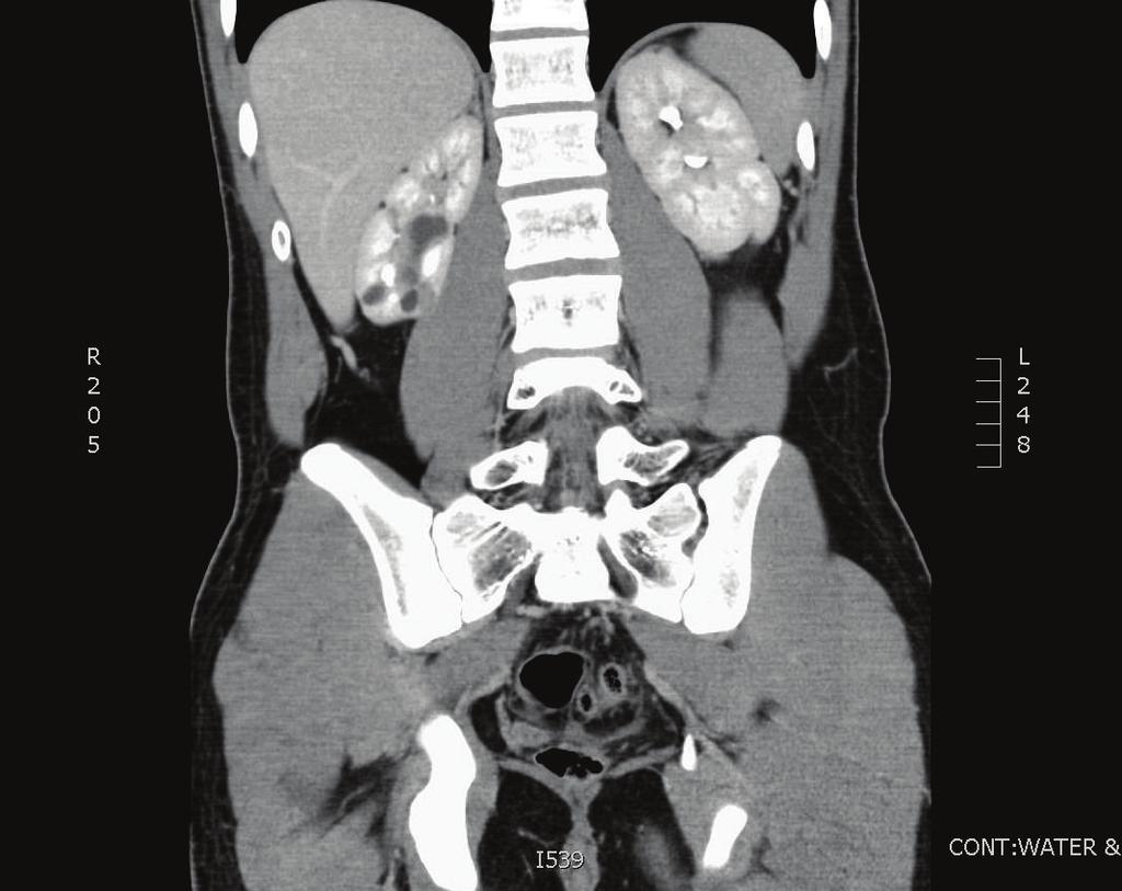 Case Reports in Urology 3 Figure 3: CT scan with contrast showing dilated calyces and associated cortical thinning in the lower pole of the right kidney. The left kidney appears normal.