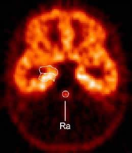 Panic Disorder and 5HT1a Receptor PET scan shows distribution of serotonin 5-HT1A receptors (front of brain is at top), which were reduced by about