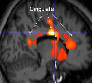 Statistically-analyzed PET scan data superimposed on structural MRI scan (front of brain is at right) shows areas in the anterior and posterior