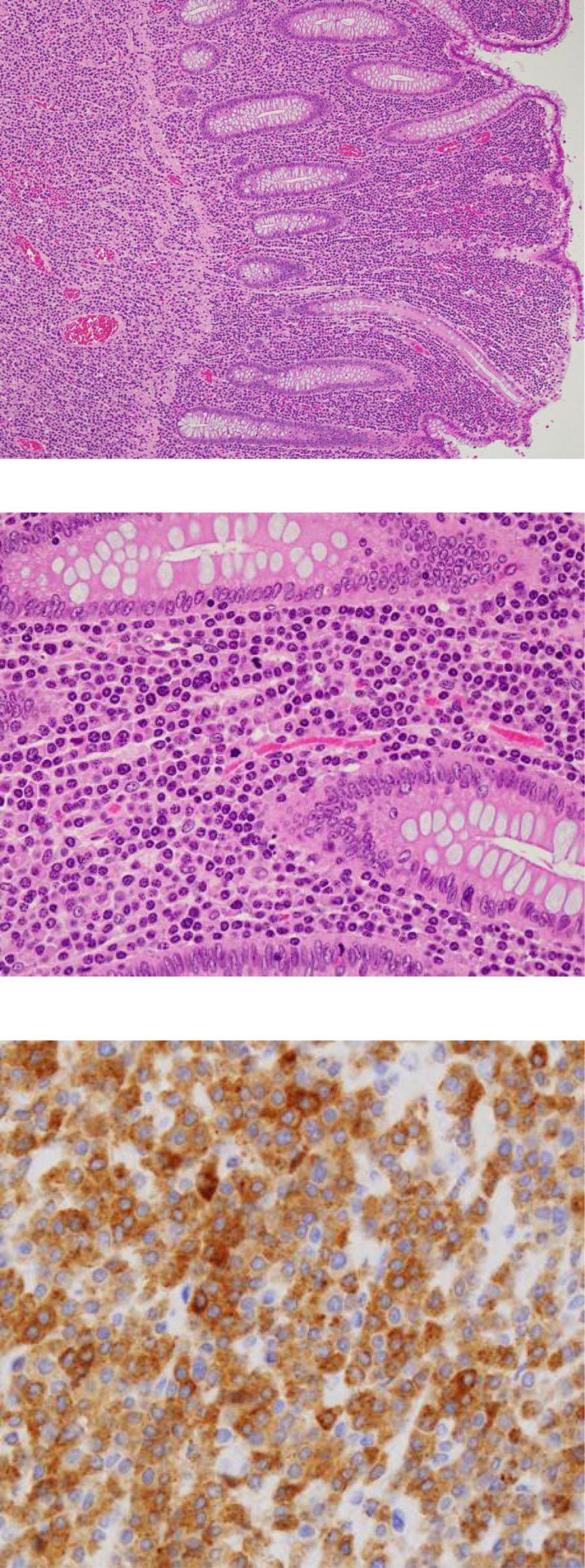 Kitmur et l. Surgicl Cse Reports (2018) 4:28 Pge 3 of 5 c Fig. 4 Immunohistochemicl exmintion., In situ hyridiztion shows tht most of the tumor expresses immunogloulin G nd lmd light chin mrna.