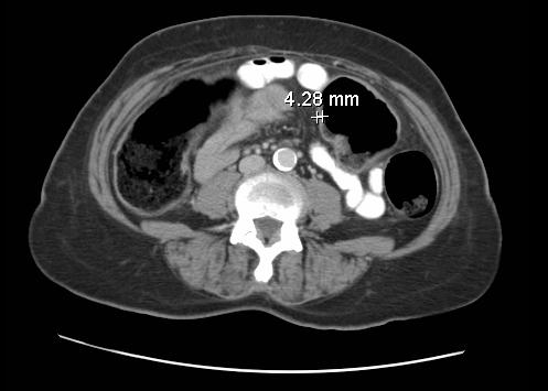 Patient 1: EJ Thickened bowel wall Small bowel loops normal in caliber No bowel wall pneumatosis Mural calcifications on aorta No free