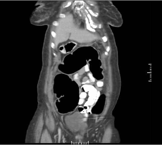 Patient 1: EJ Diffuse dilation of colon, most prominent in ascending, transverse,