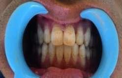 patient was referred to the department with a chief complaint of discoloration of upper front teeth since 2 years. Patient had no relavent medical history.