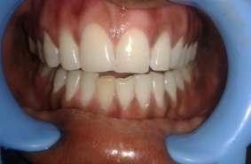 The case was diagnosed as moderate form of fluorosis.