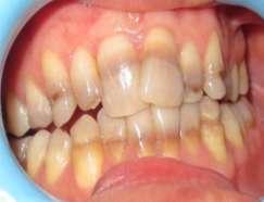 difficult to manage by veneers or bleaching. Direct partial composite veneering was done forall six mandibular anterior teeth which resulted aesthetic improvement (Figure 12).