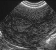 Anatomic Causes Non-Cancerous Uterine, Cervical, Vaginal: Fibroids Polyps Adenomyosis Trauma Atrophy Cancerous: Endometrial Cancer