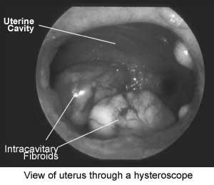 Hysteroscopic Myomectomy Works well with