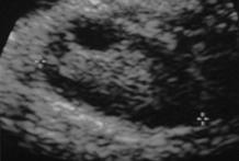 Endometrial Surveillance: US & Other Imaging Thickened endometrium can be atrophic.