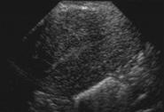under < 35-40 if obese or chronic anovulation Perform if persistent abnormal bleeding despite medical therapy Endovaginal Ultrasound Instead?