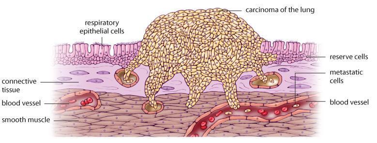 LUNG CANCER uncontrolled cell division a carcinoma (tumour) forms and can grow large enough to reduce respiratory surface area tumour can break away and form more elsewhere (metastasis) symptoms: