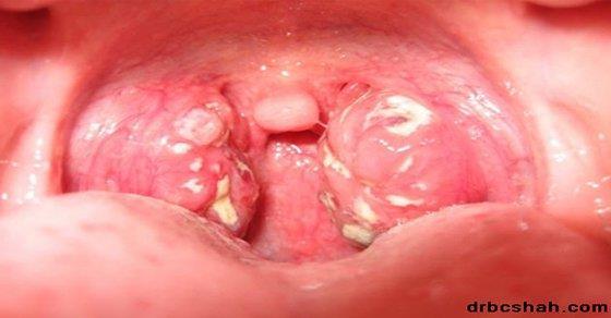 TONSILLITIS Infection of the tonsils Bacterial or viral Symptoms: red and swollen tonsils, sore throat, fever, swollen glands