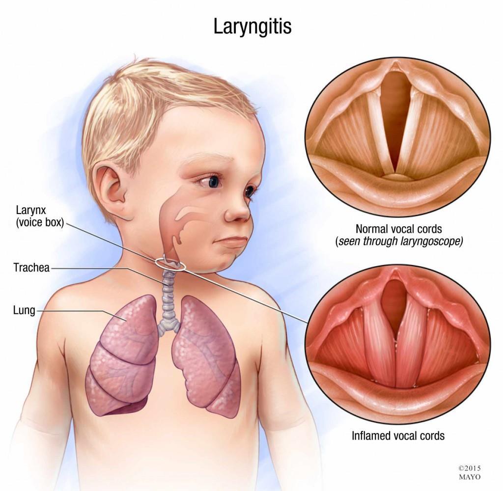 LARYNGITIS Inflammation of larynx Causes: infection