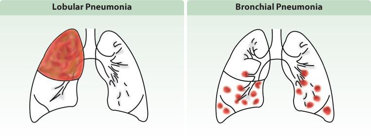 PNEUMONIA Inflammation and fluid build-up in alveoli Bacterial or viral Types: lobular and bronchial Treatment: antibiotics (bacterial), anti-virals, vaccines Lobular pneumonia