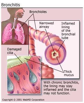 BRONCHITIS Inflammation, redness, extra mucus in membranes of bronchi Mucus expelled by coughing short term: caused by a bacteria