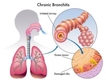BRONCHITIS chronic bronchitis: aka COPD (chronic obstructive pulmonary disease) and leads to infection,