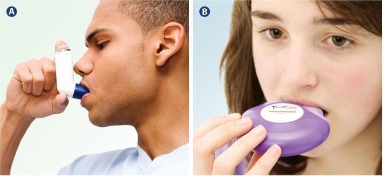ASTHMA Inflammation of bronchi and chronchioles Trigger: pollen, dust, smoke narrows air passages, reduces airflow symptoms: wheezing, coughing,