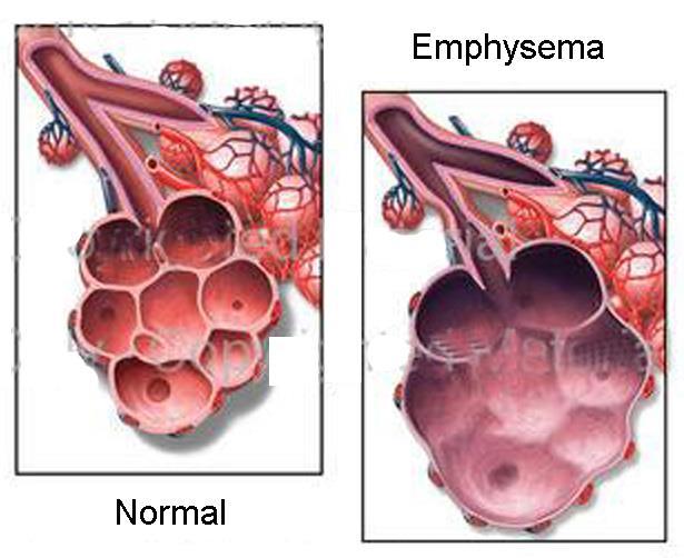 EMPHYSEMA Alveolus walls lose elasticity Reduces respiratory respiratory surface for gas exchange breathing is laboured due to collapsed bronchioles a