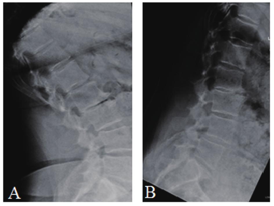 Quantify Improvements After X-Stop Procedure J Med Cases. 2015;6(5):205-210 Figure 2. (A) Preoperative standing lateral radiographs of the patient in extension.