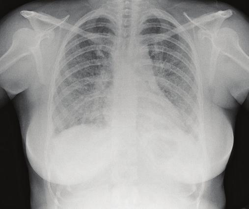 2 Case Reports in Rheumatology Figure 1: Chest X-ray pre-and postdiscontinuation of anti TNF-α therapy and commencement of oral prednisolone.