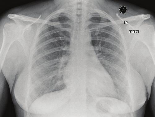 Chest X-ray showing improvement in the extent of reticulonodular shadowing post-discontinuation of anti-tnf-α therapy and the commencement of oral prednisolone.
