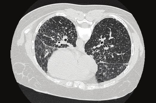 High resolution computed tomography showed multiple small nodules throughout the lung, few peribronchovascular nodules, with multiple enlarged mediastinal and hilar lymph nodes. 2.