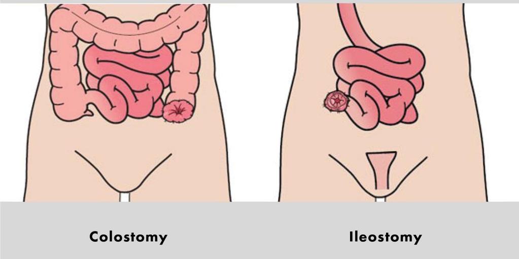 Colostomy & Ileostomy Indications, problems and preference By