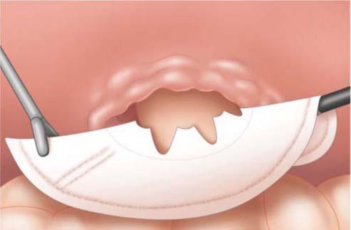 gastro intestinal stomas 17 a b 3 5 cm Beyond Defect c d Figure 11 Laparoscopic encirclement mesh repair of parastomal hernia.