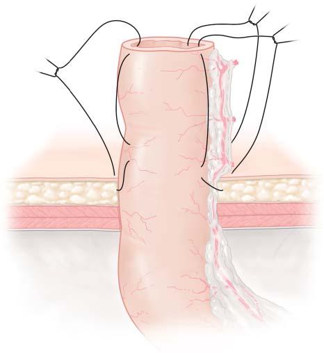 (a) Care is taken when dividing the blood supply of the right colon to preserve the arcades supplying the terminal ileum. The line of division of the vessels and the mesentery is shown (dashed line).