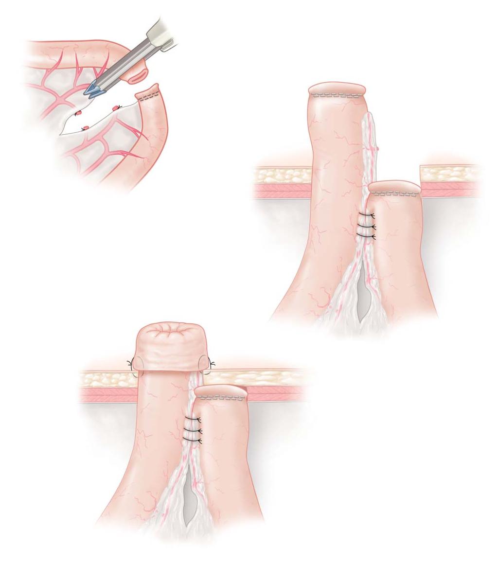 gastro intestinal stomas 8 a b c Figure 6 Divided loop ileostomy.