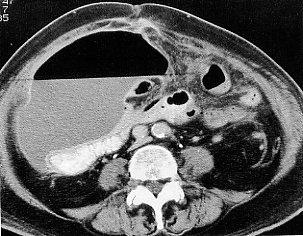 Intraperitoneal Abscess