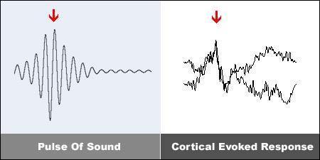 What Is Brainwave Entrainment? When the brain is given a stimulus, through the ears, eyes or other senses, it emits an electrical charge in response, called a Cortical Evoked Response (shown below).