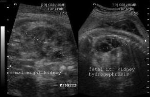 Obstructive Urinary Tract Abnormalities Sonographic findings: AP renal pelvic diameter greater than 5 to 10 mm Rim of renal parenchyma