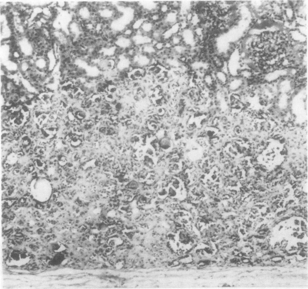2 Subcapsular focus of sclerosing renal nephroblastic dysplasia. Haematoxylin and eosin xss. J Clin Pathol: first published as 10.1136/jcp.35.10.1069 on 1 October 1982. Downloaded from http://jcp.bmj.