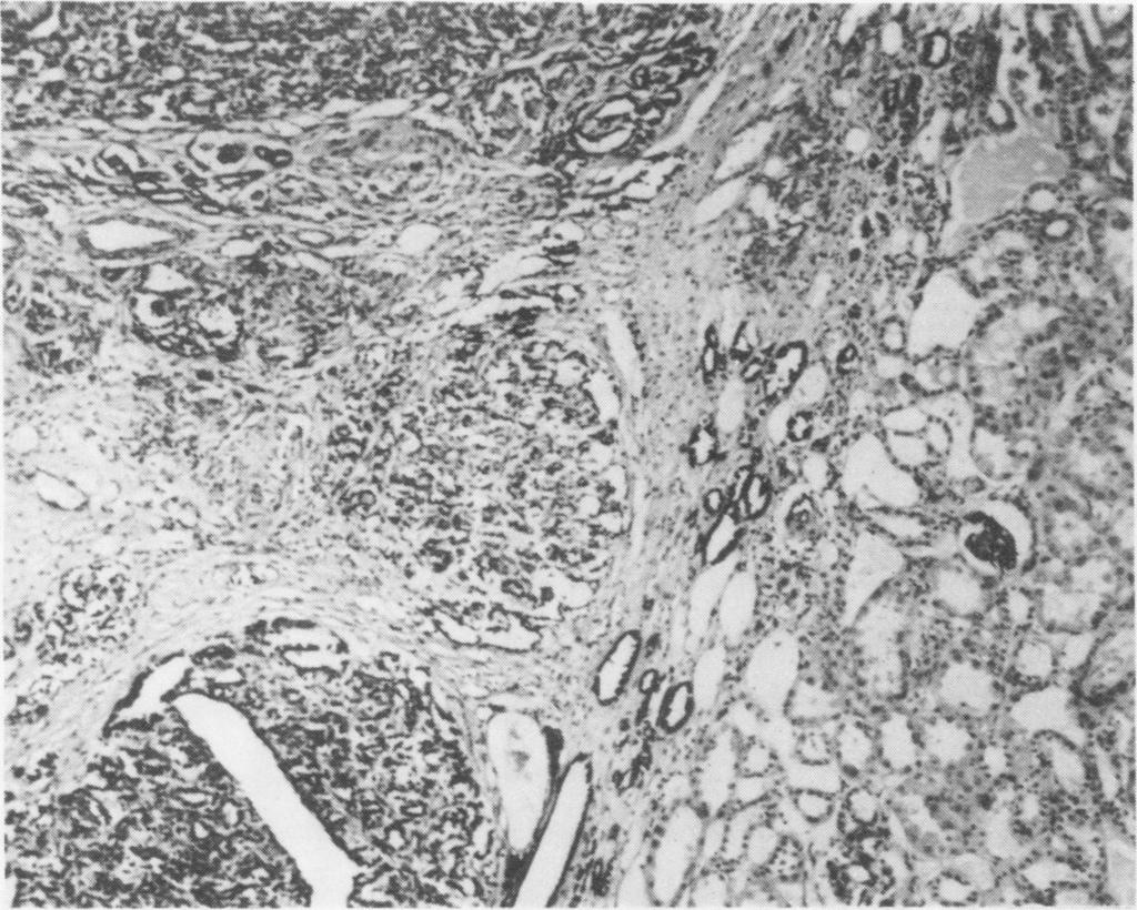 Wilms' tumour and renal dysplasia: an hypothesis During normal kidney development, pluripotential metanephrogenic blastema becomes committed to form purely renal tissue.