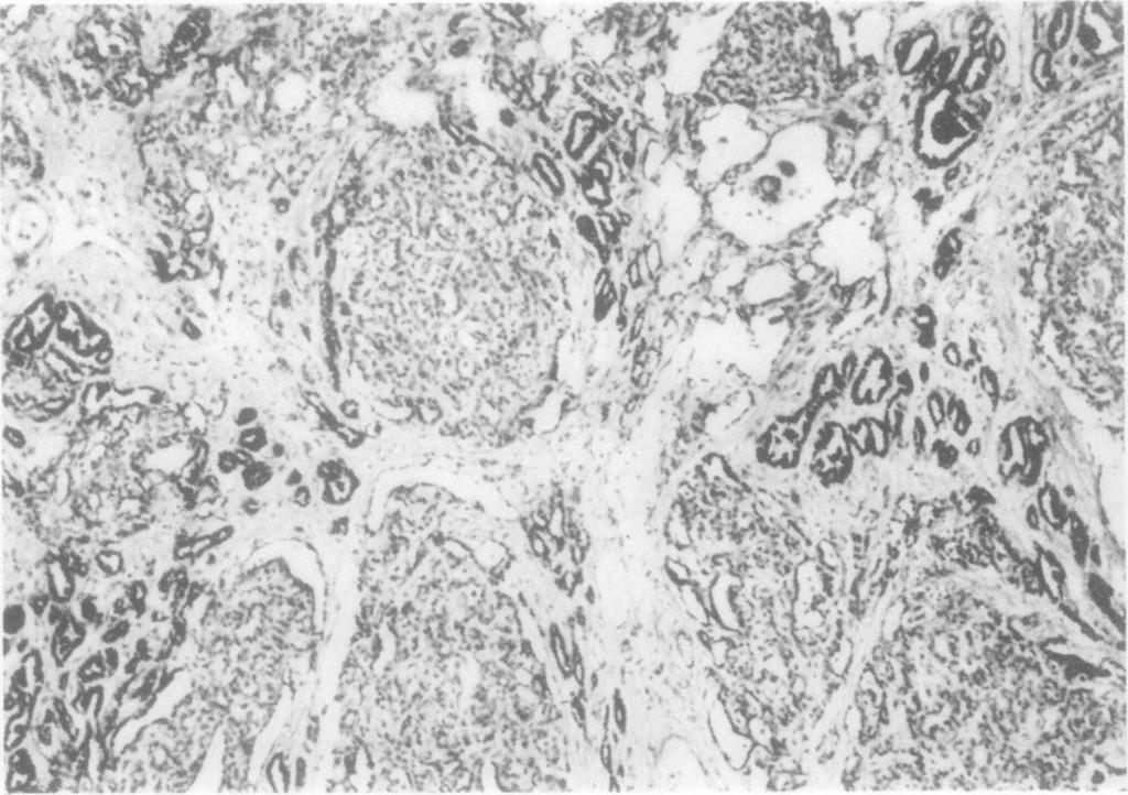 . mo Marsden, Lawler Fig. 5 Nephroblastic dysplasia within a highly differentiated epithelial Wilms' tumour.