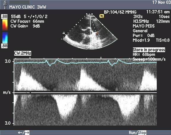 replaced to prevent right ventricular