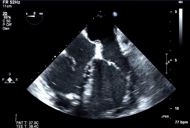 Mitral Ring Supramitral ring: fibrous membrane just above the mitral annulus. Does not adhere to the leaflets.