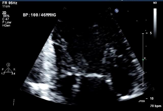 Mitral Arcade Caused by an arrest in the developmental stage of the mitral valve before attenuation and lengthening of the chordae Chords are thickened,