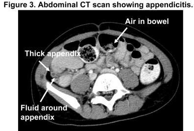 1. Diagnostic accuracy of NONCONTRAST Computed Tomography for Appendicitis in