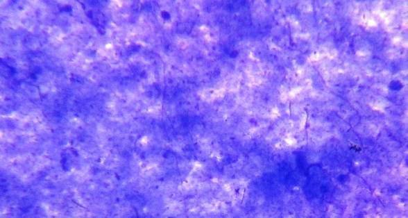3 Microphotograph showing scattered bright, straight or slightly curved rods of tubercular bacilli (ZN staining x1000) Fig.